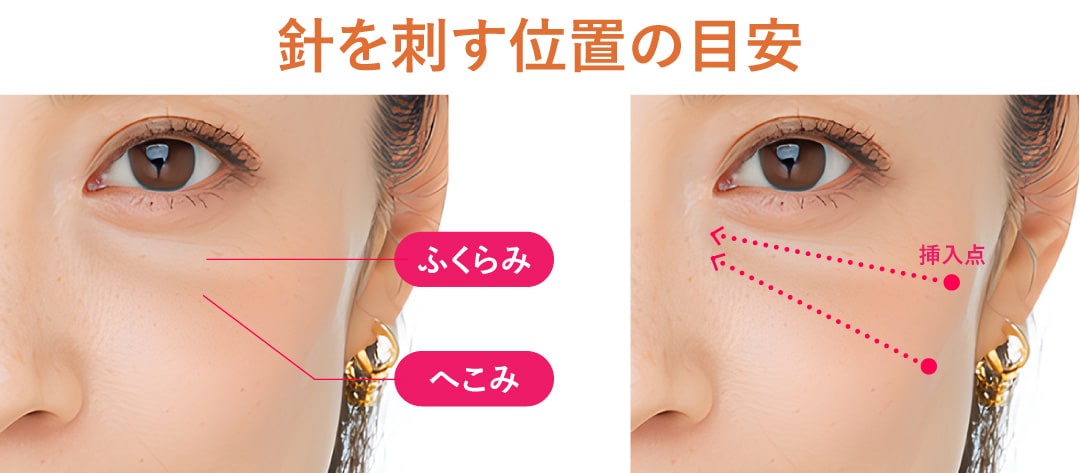 施術の手順