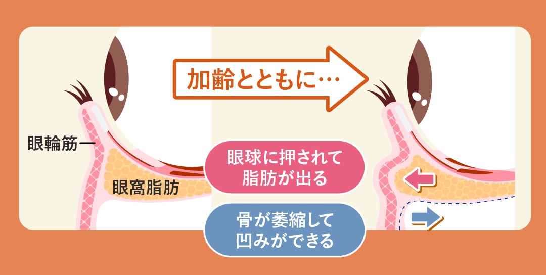 美容針で「クマ」改善!?