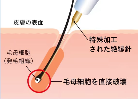 ニードル脱毛の仕組みを解説