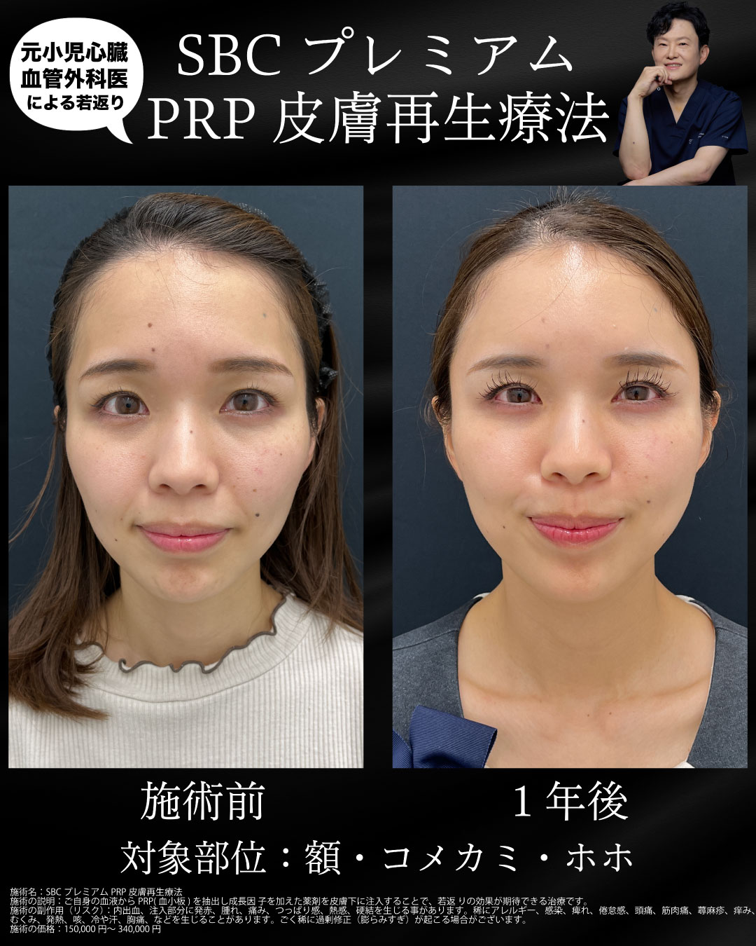 PRP