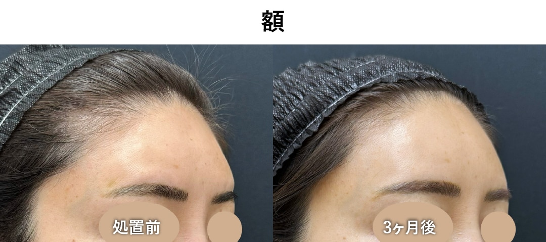 ゴツゴツ感のある「額」改善