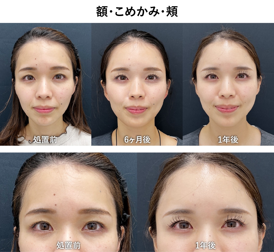額・こめかみ・頬
