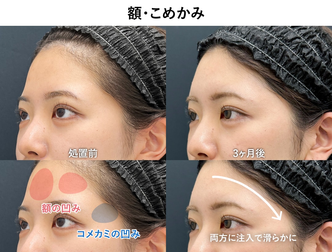 「額」をするなら「コメカミ」もセットがオススメ!