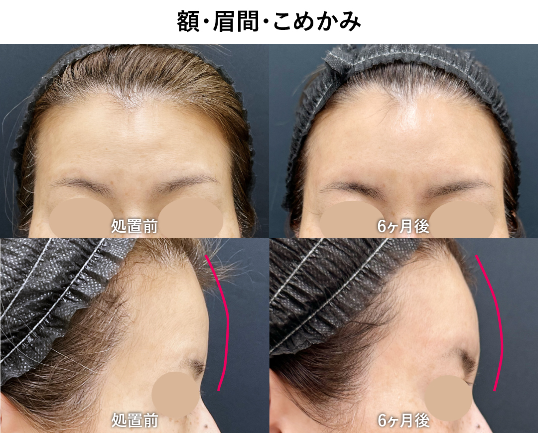 額の骨の形によって「眉間」も一緒に!