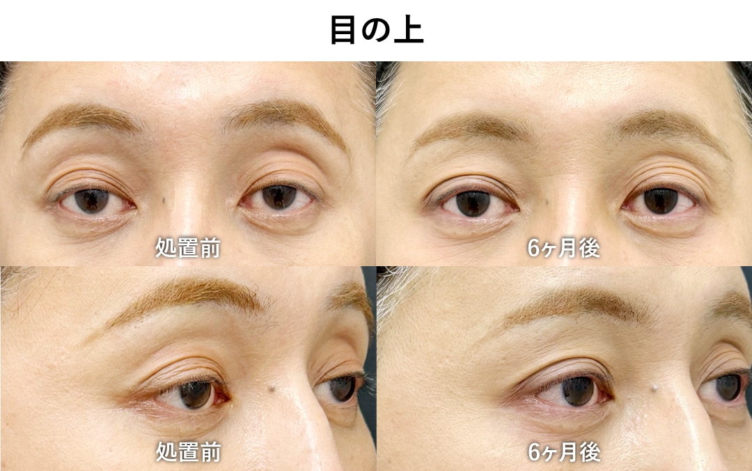 目の上の凹みにも✨