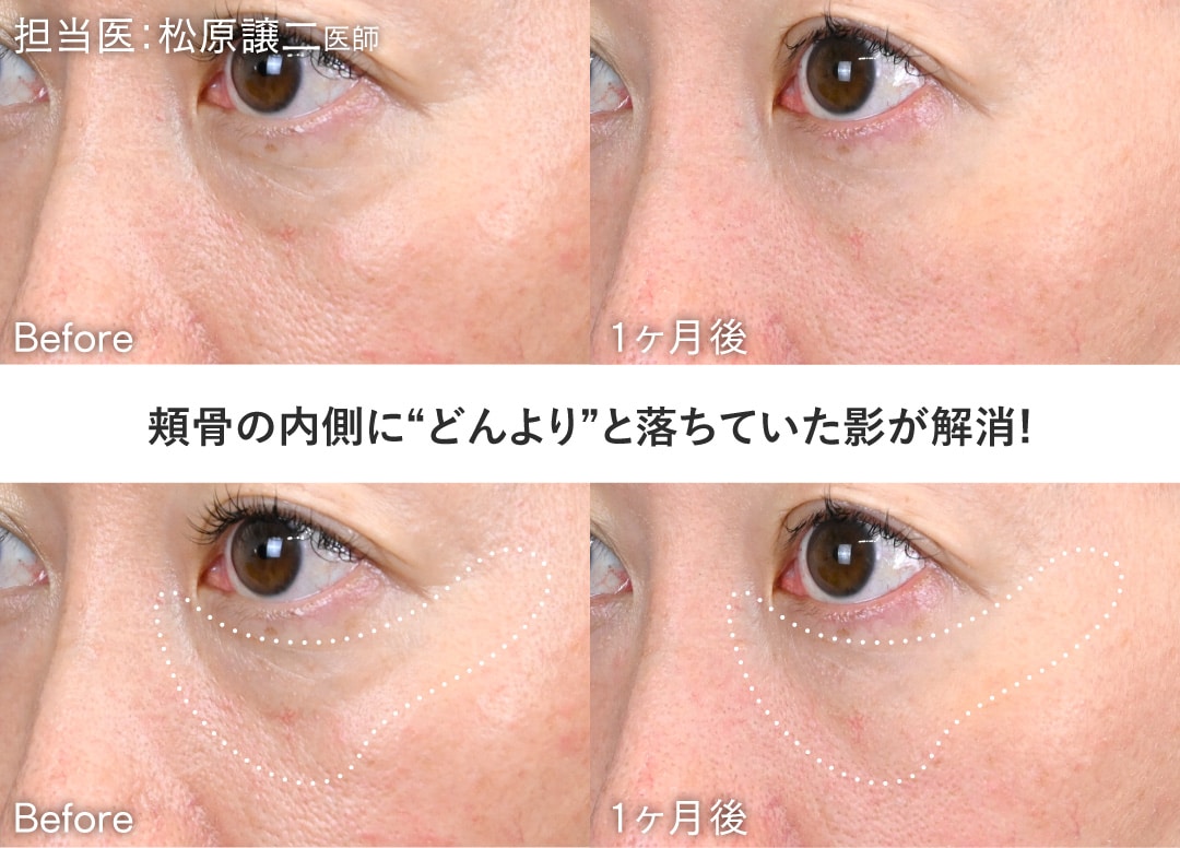 目の下の「どんより影」解消✨