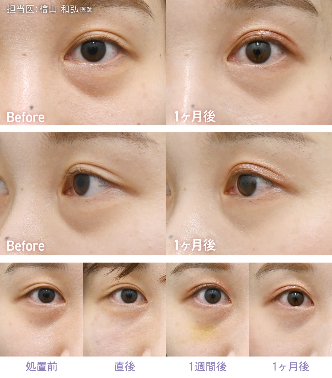 20代後半女性 / 目の下1本