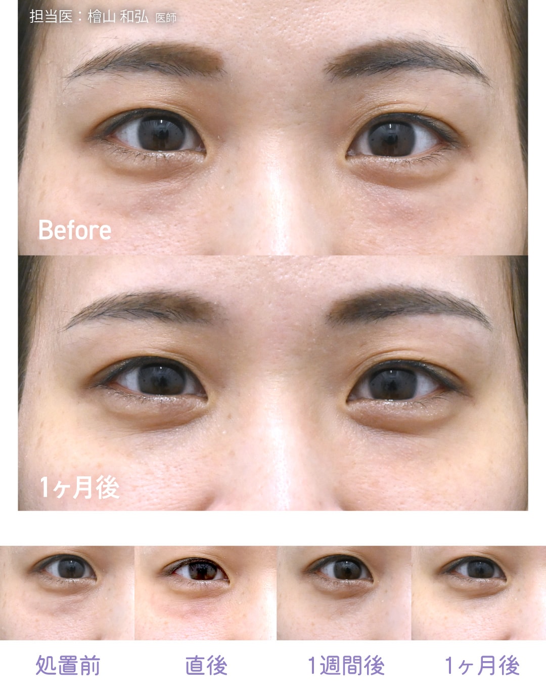 30代後半女性 / 目の下1本