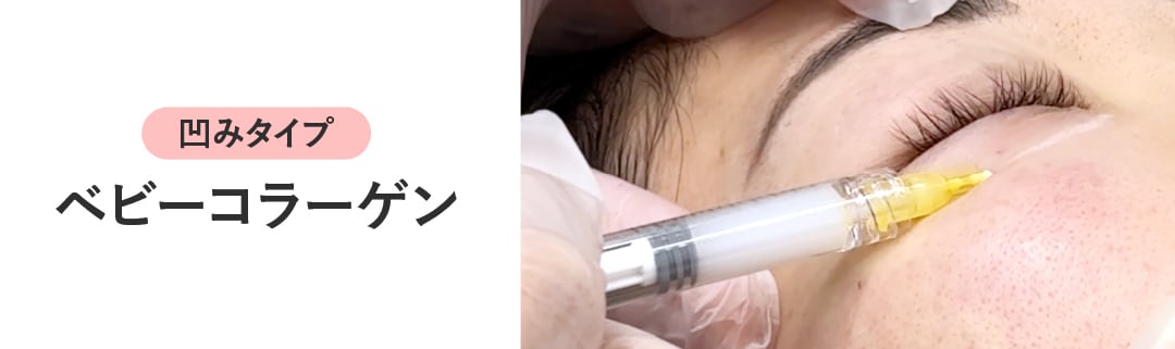 ベビーコラーゲンはどんな治療？