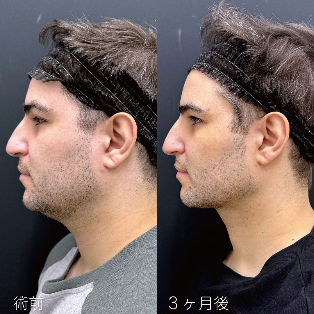 エンブレイスで“脂肪のつき方に合わせた緻密なデザイン”