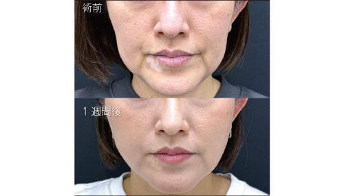 糸リフトの効果