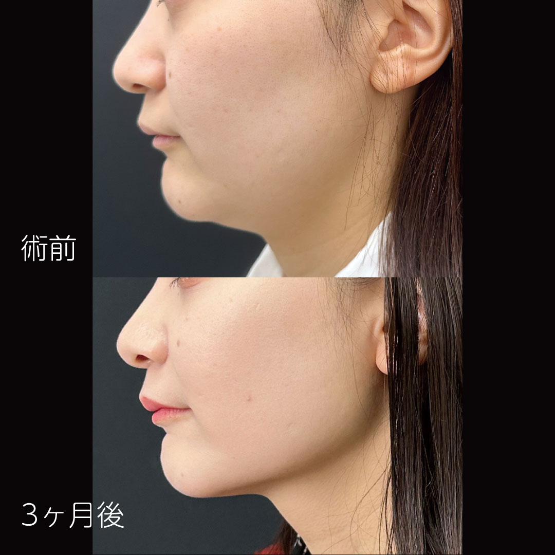 ダウンタイム最小限で、最大限の変化を