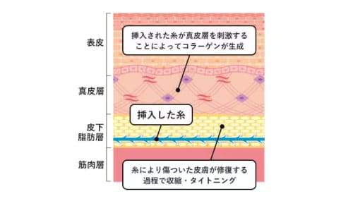 糸リフトはどんな施術？