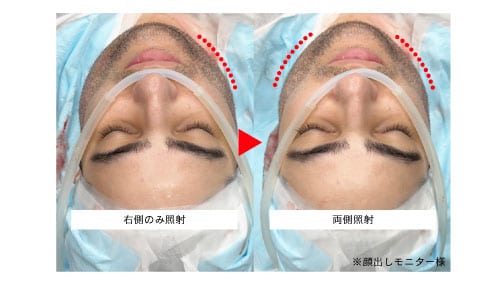 エンブレイスRFの効果