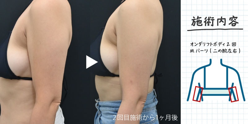 オンダリフトボディ