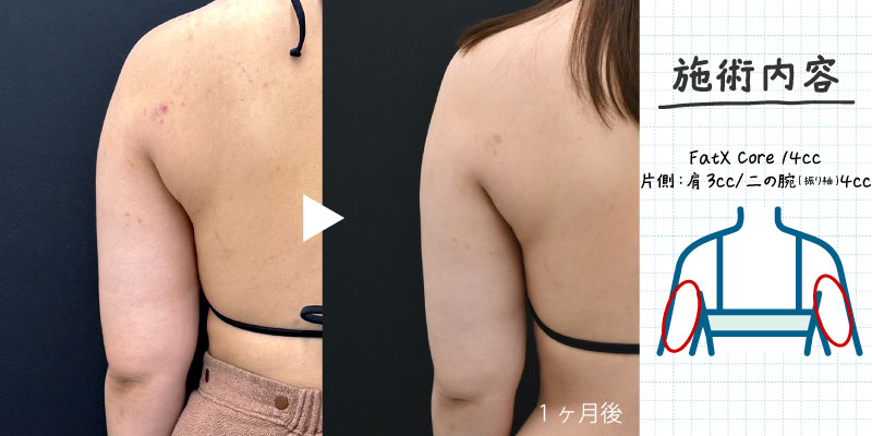 FatX Core(脂肪溶解注射)