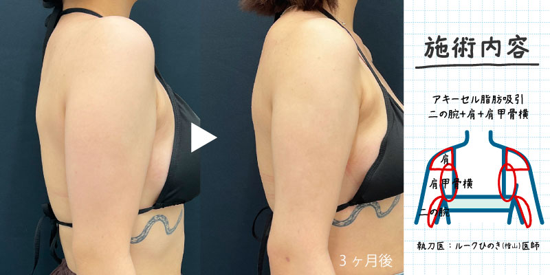 ルークひのきの二の腕脂肪吸引<br />
(ナチュラルな変化を求める方におすすめ)