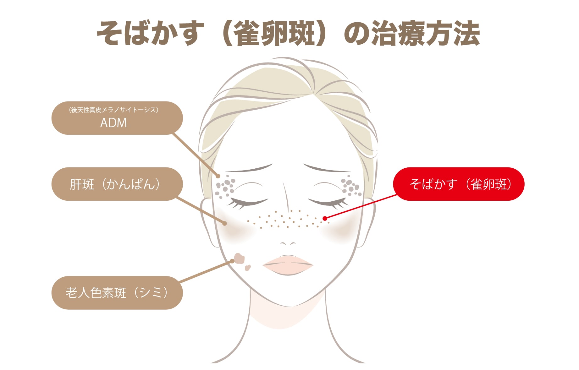 そばかす（雀卵斑）