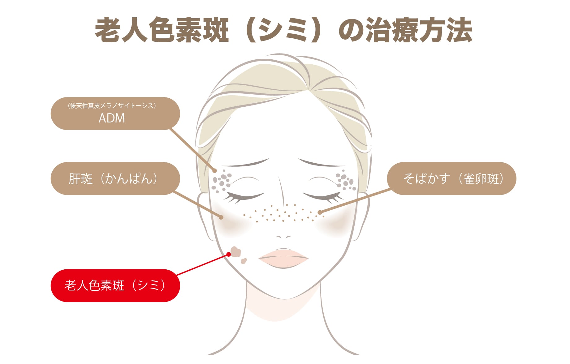老人色素斑（シミ）