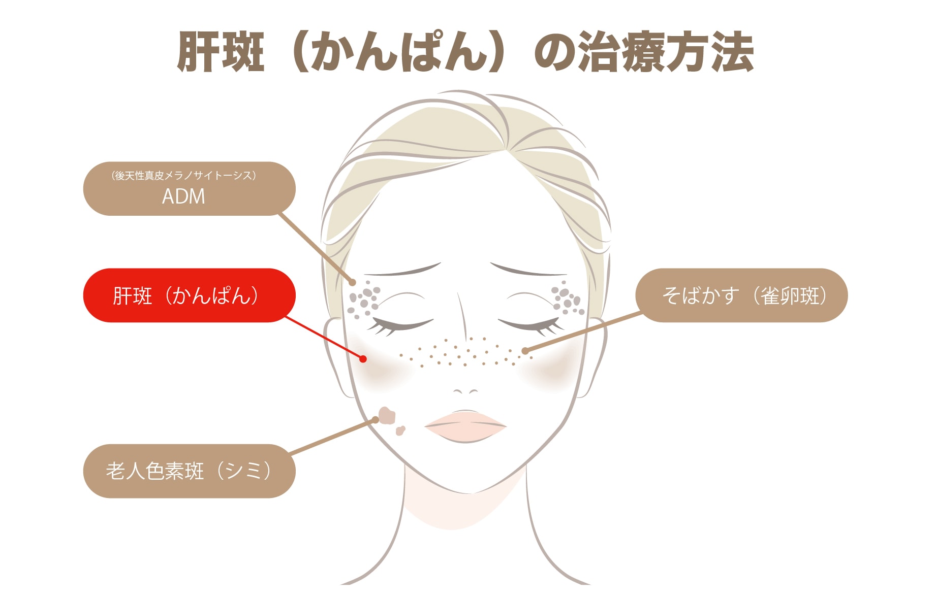 肝斑（かんぱん）