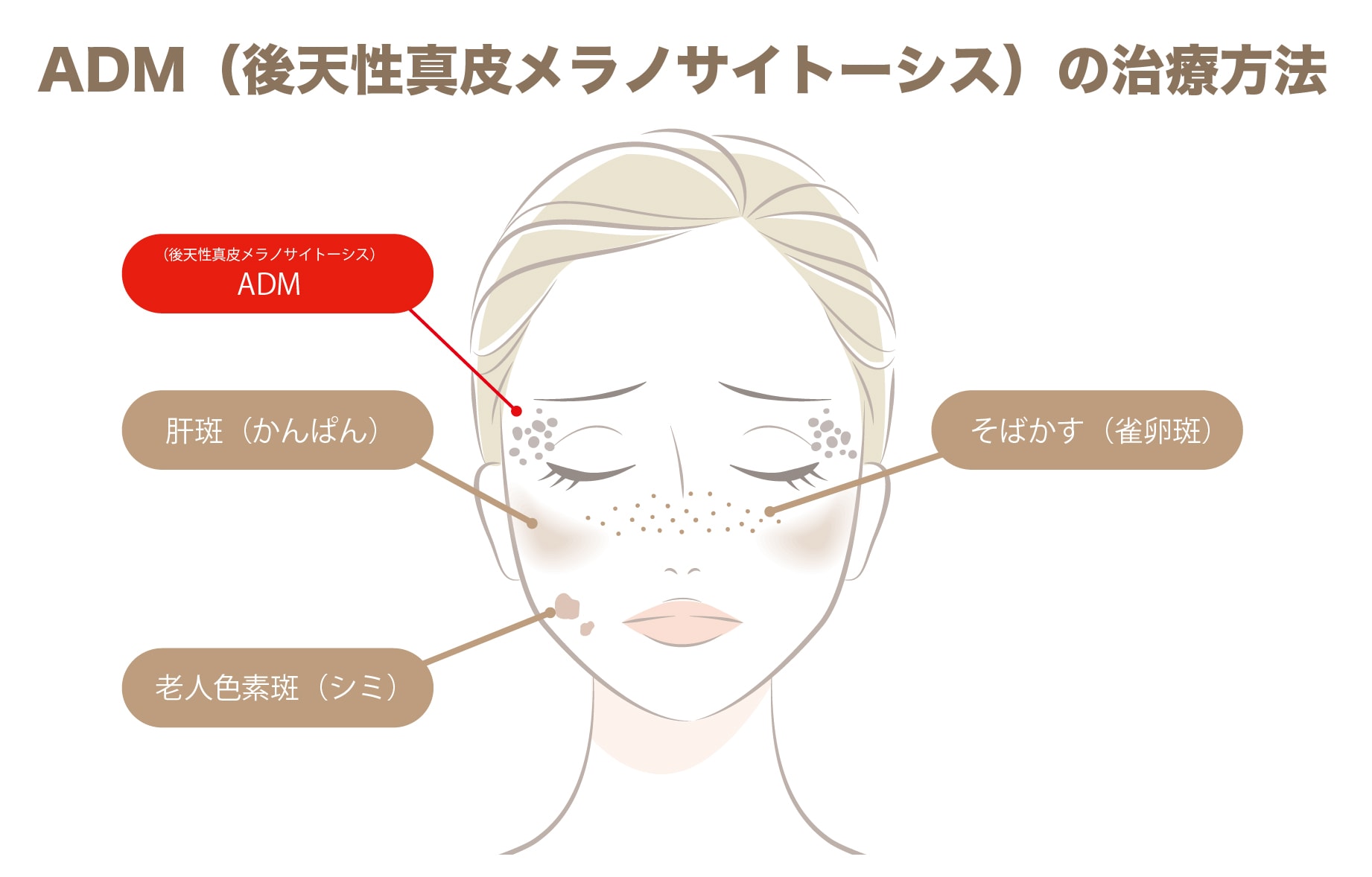 ADM（後天性真皮メラノサイトーシス）