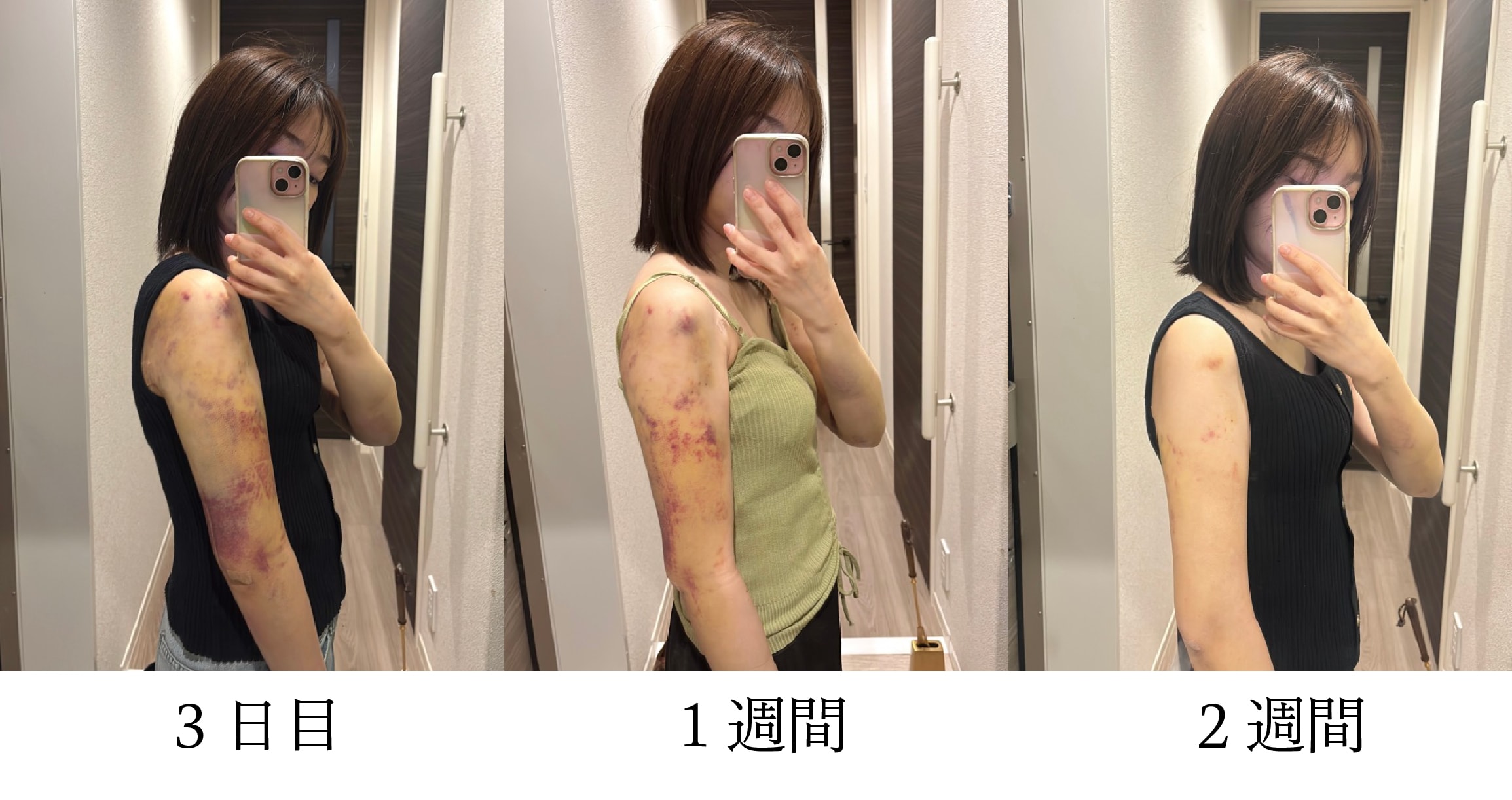 実際に施術を受けたスタッフAさん<br />
 ※経過には個人差があります