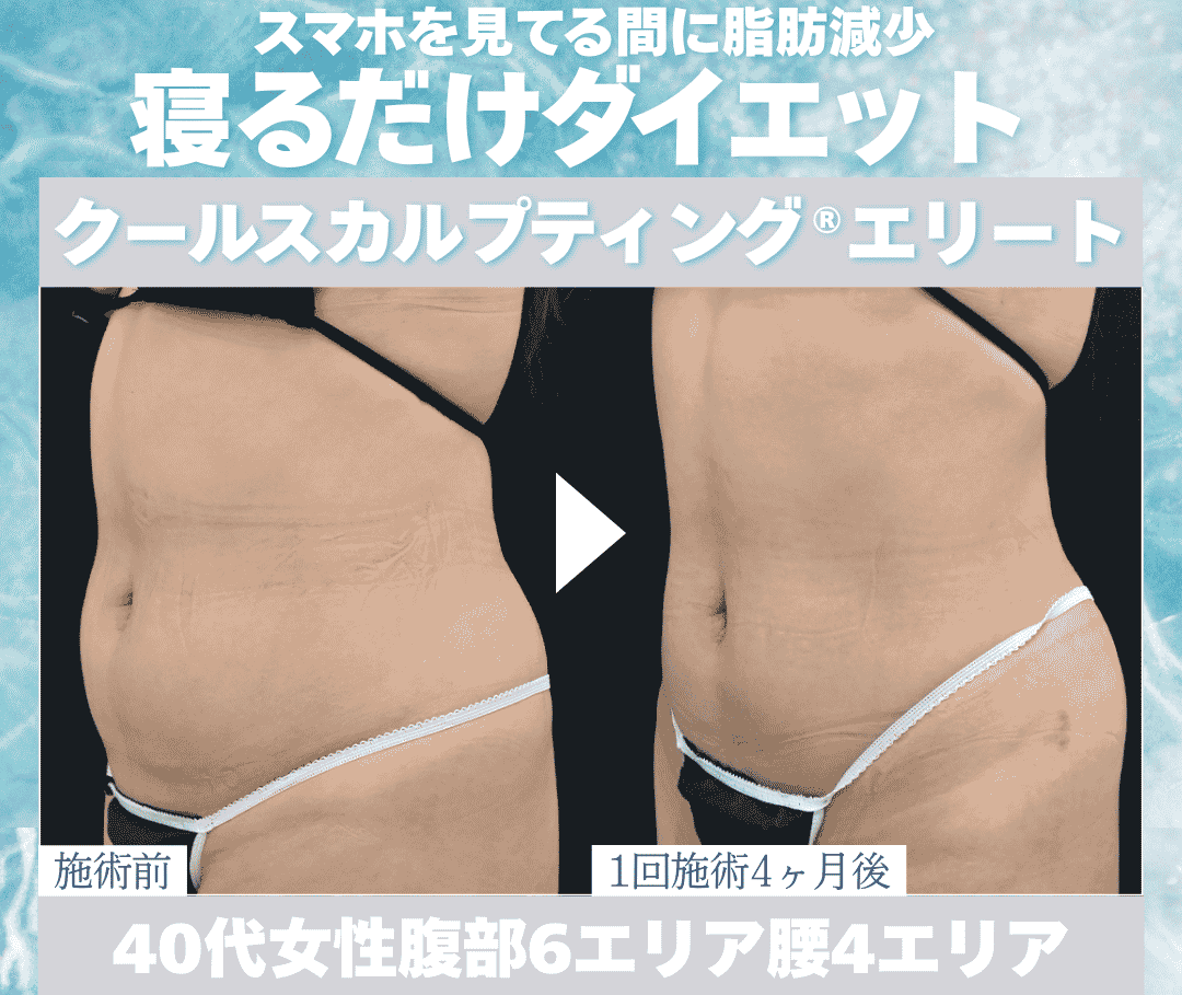 新宿でスマホを見ている間に脂肪減少！寝ながらダイエット！クールスカルプティング®エリート【湘南美容クリニック新宿南口院】