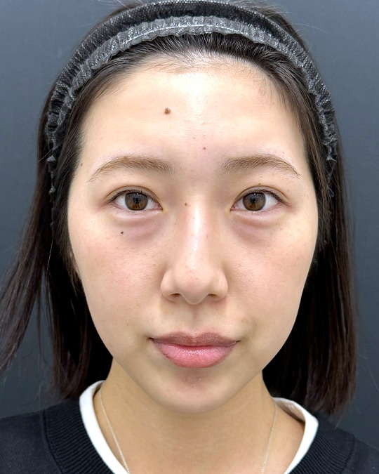 施術前　メイクなし