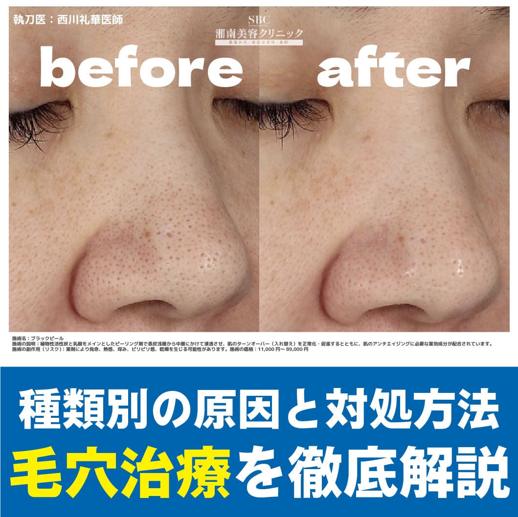 新宿で叶える!毛穴(開き・黒ずみ・つまり)の原因と対処方法を徹底解説!湘南美容クリニック新宿南口院
