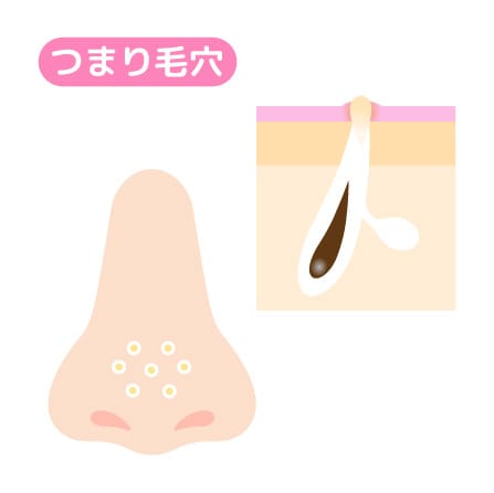 角栓が毛穴をふさいでできるつまり毛穴