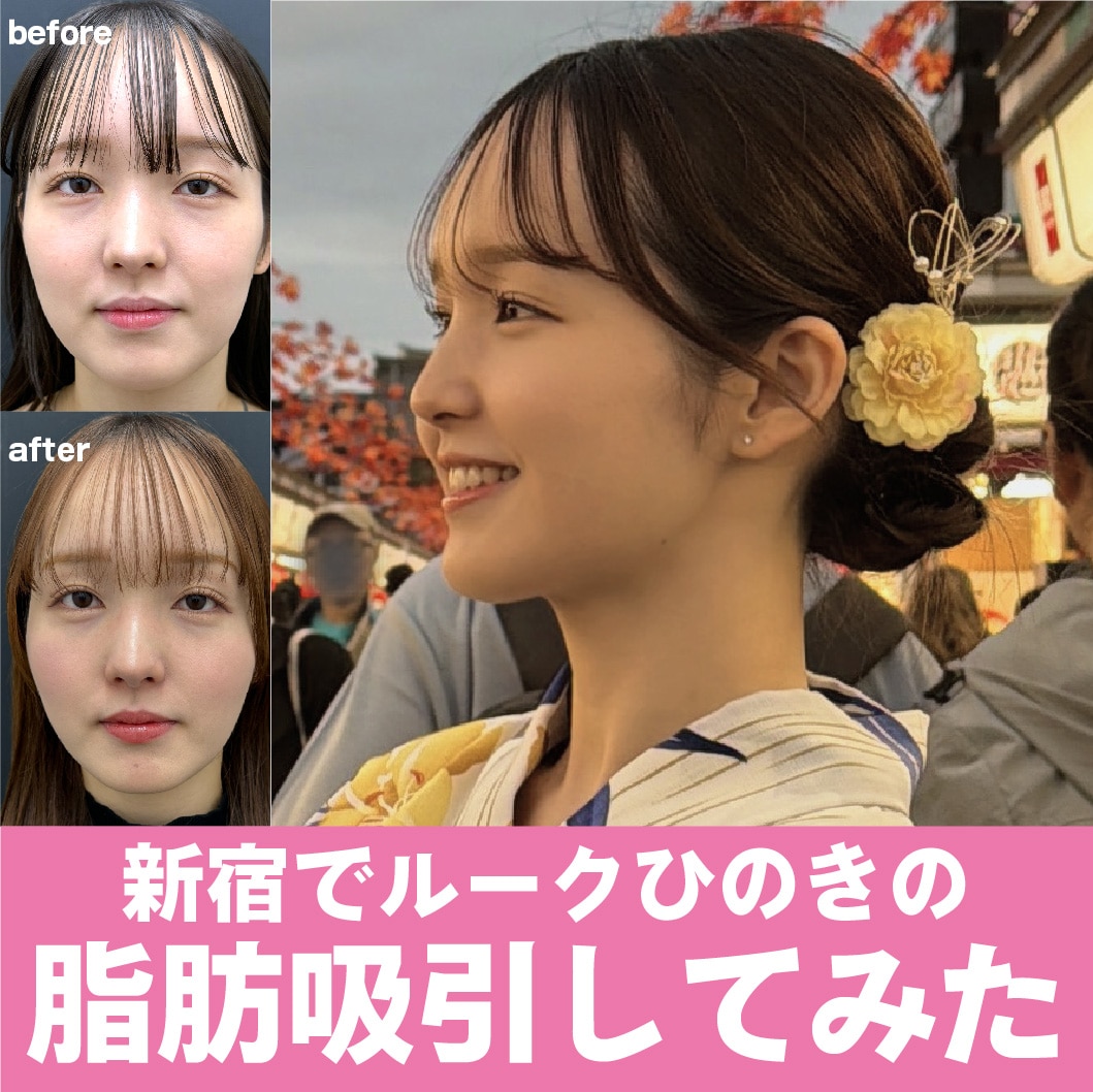 【2026年最新】新宿駅近く！アキーセル脂肪吸引×ベイザー×エンブレイス×糸リフトで叶える小顔・輪郭形成！湘南美容クリニック新宿南口院