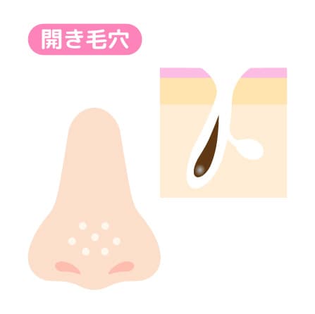 毛穴が開いてできる開き毛穴(すり鉢毛穴)
