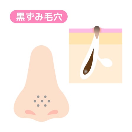 毛穴詰まりの色素沈着でできる黒ずみ毛穴