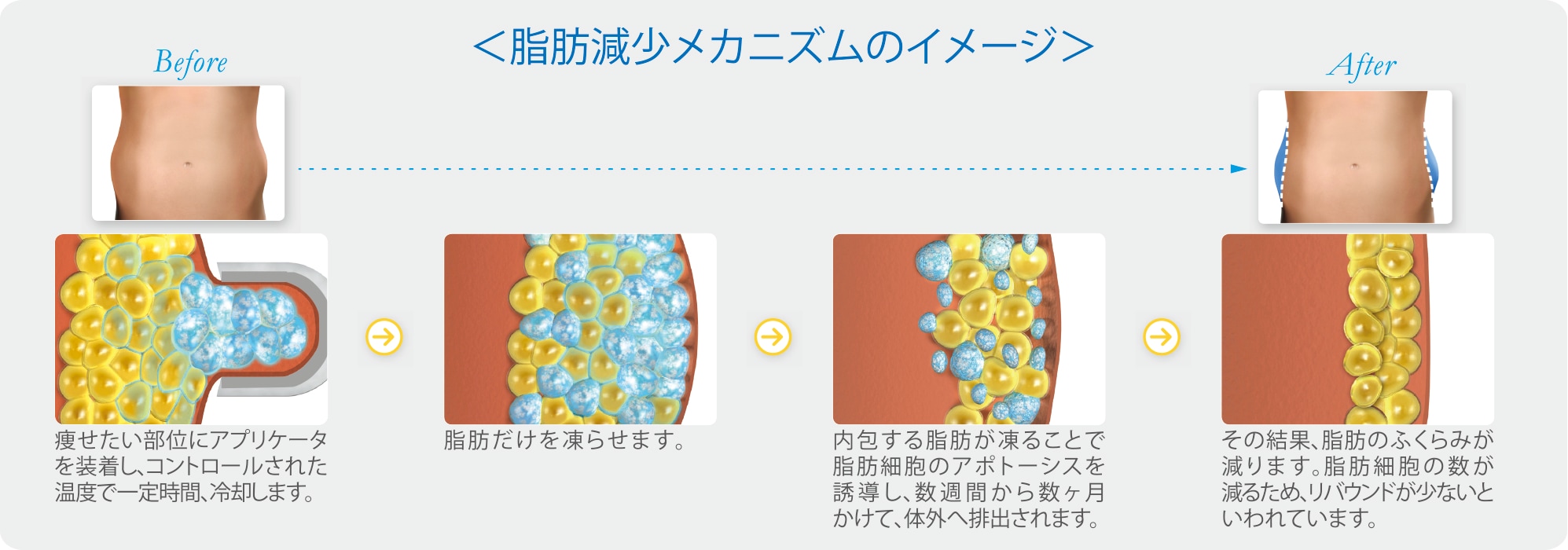 クールスカルプティング®エリートとは脂肪冷却作用により部分痩せを<br />
実現したリバウンドのない医療ダイエットです🧊