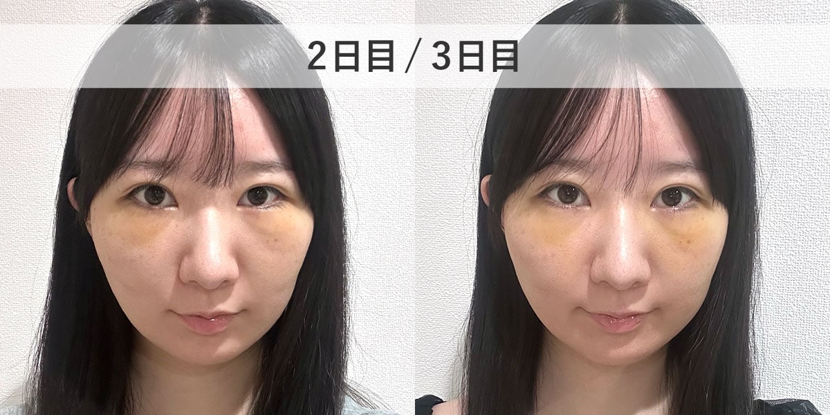 ダウンタイム2-3日目