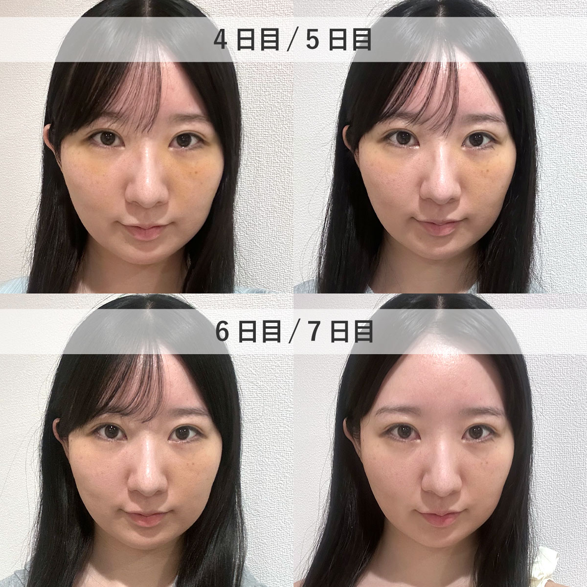 ダウンタイム4-7日目