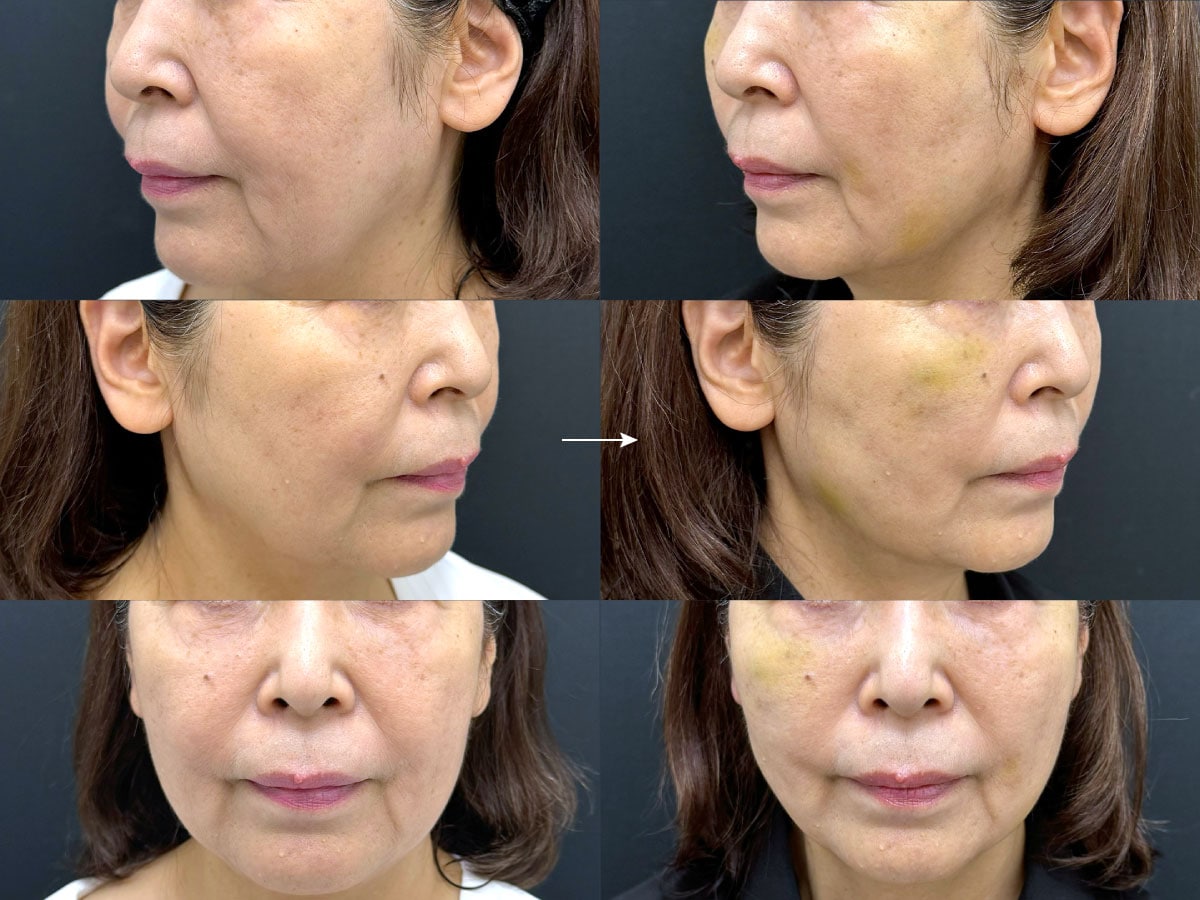 70代前半女性