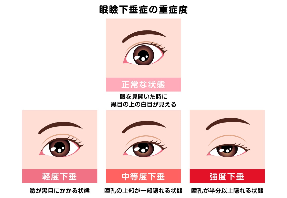 SBCデカ目術（切らない眼瞼下垂術）