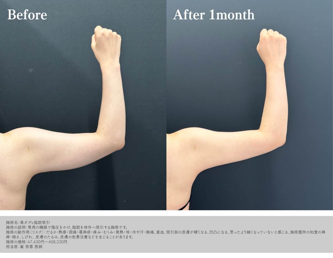 美ボディ脂肪吸引(二の腕+肩)/ 20代女性