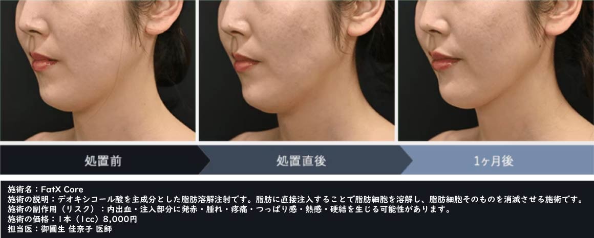 あご下3cc💉