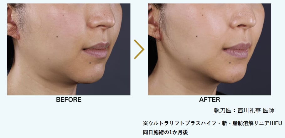 \新・脂肪溶解リニアハイフと同時施術がおすすめ/<br />