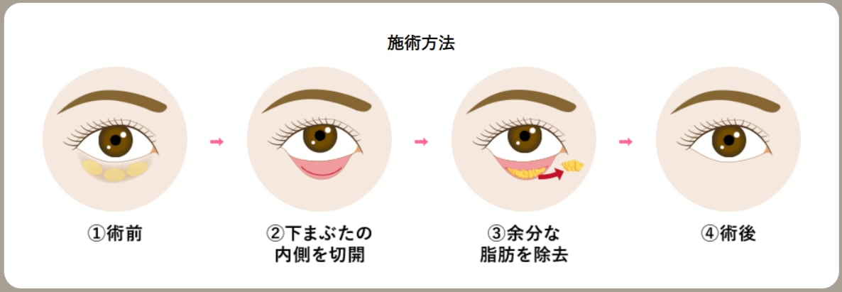 目の下の切らないクマ・たるみ取り<br />