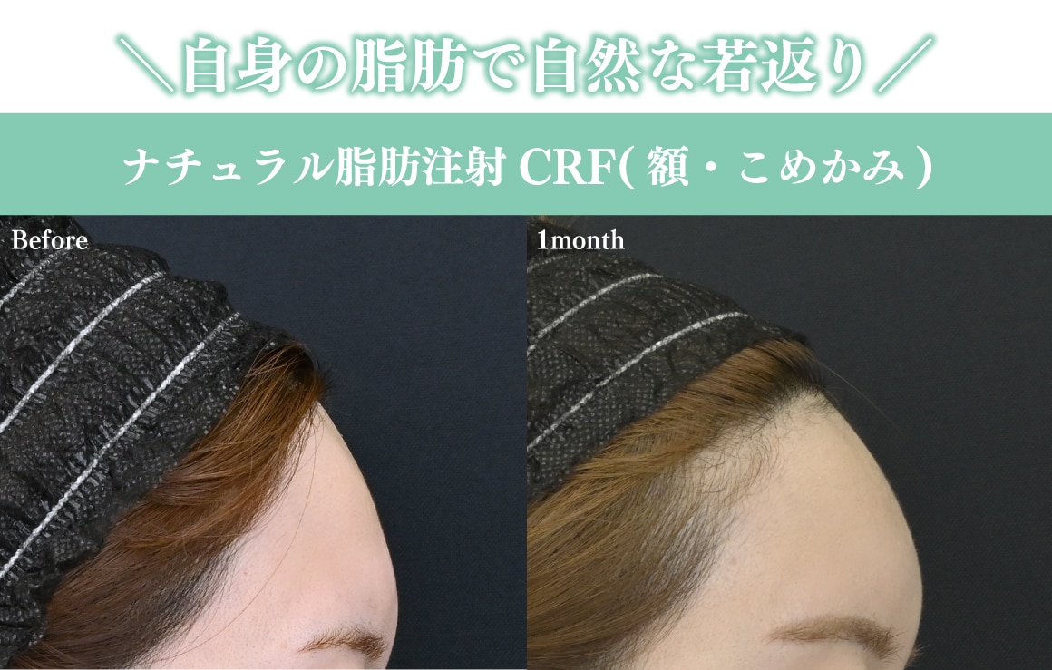 脂肪注入リードドクターによる中山先生の脂肪注入