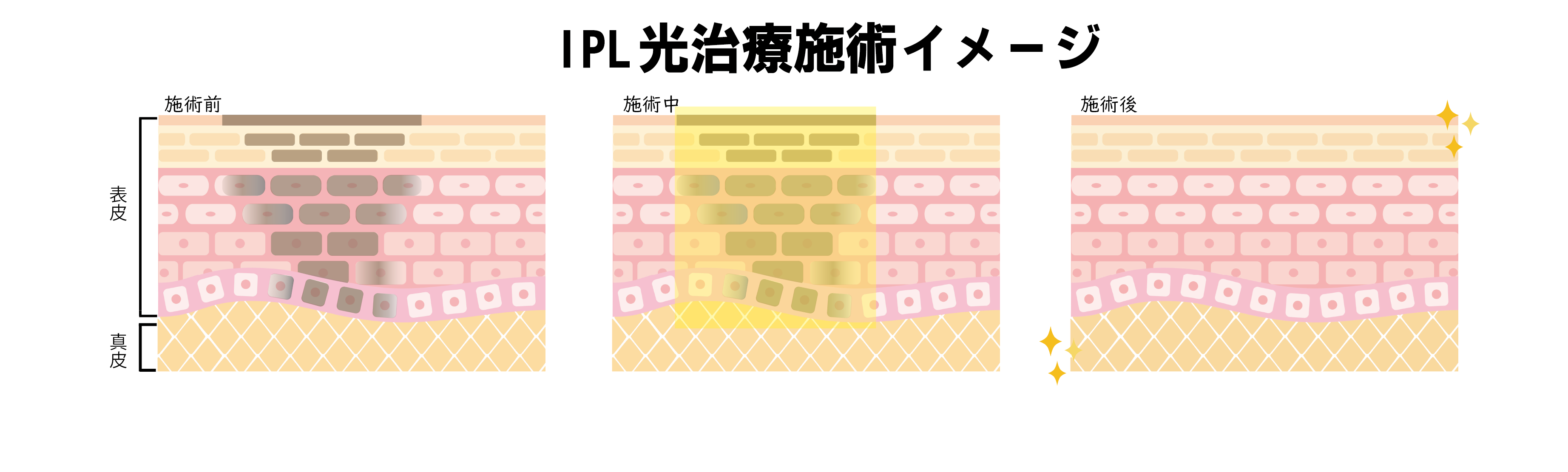 照射イメージ