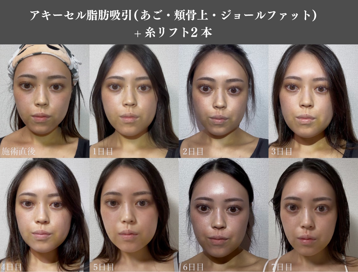 ダウンタイムの様子