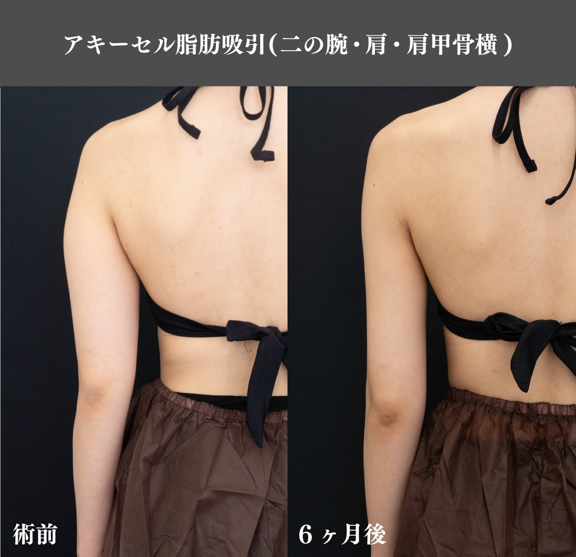 二の腕の脂肪吸引①