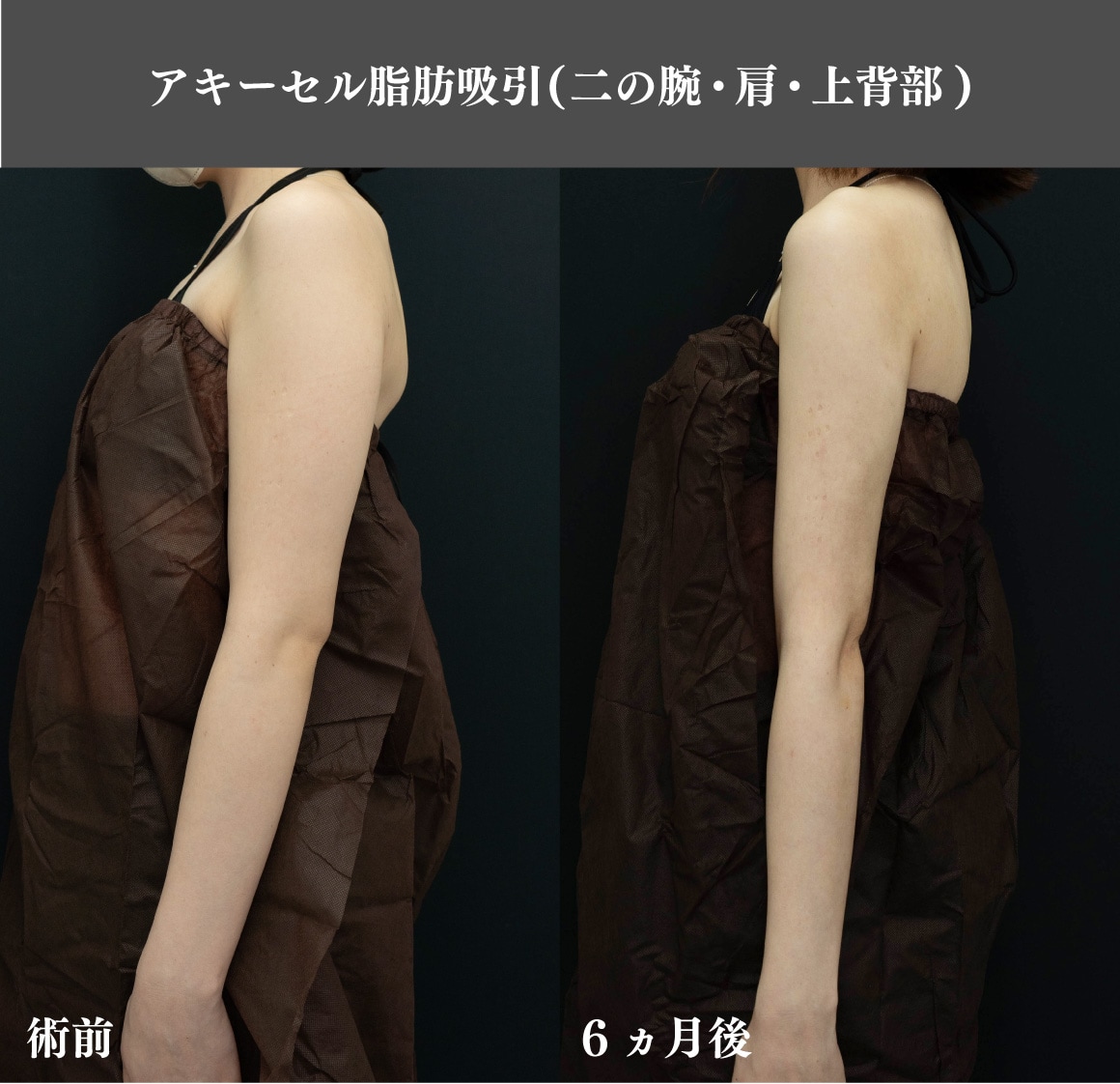 二の腕の症例紹介②