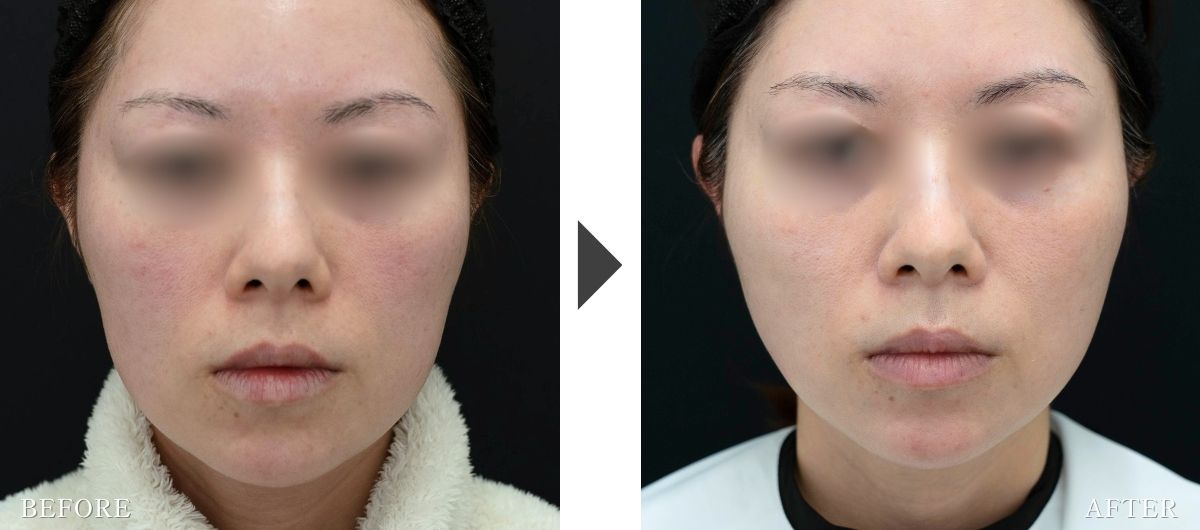 テスリフトの症例