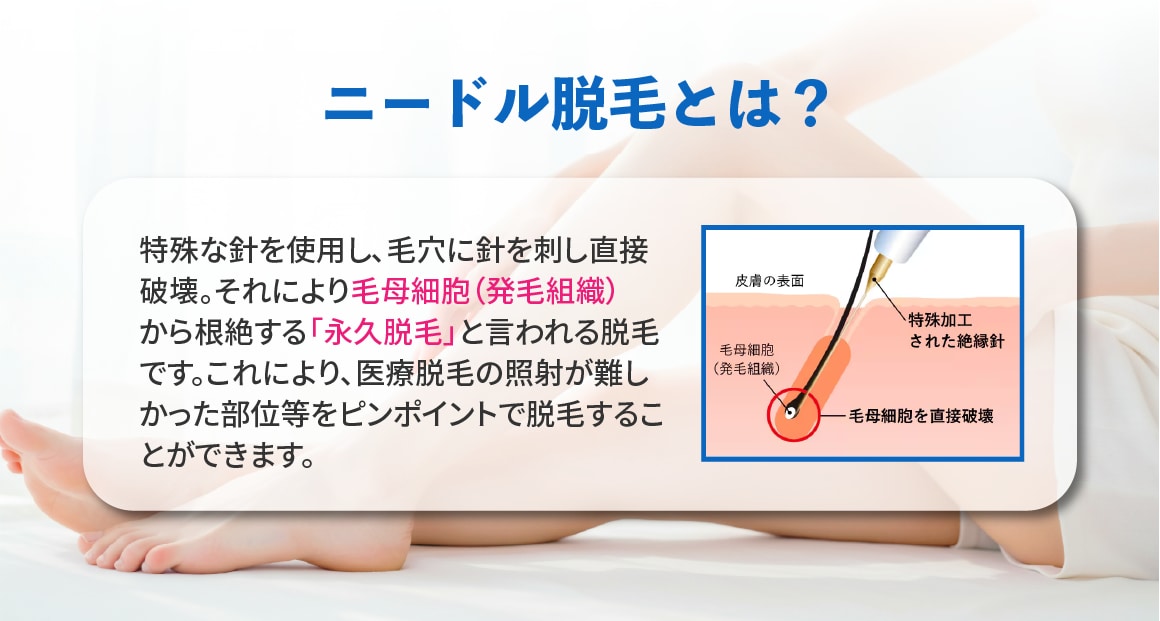 毛根をピンポイントで破壊！