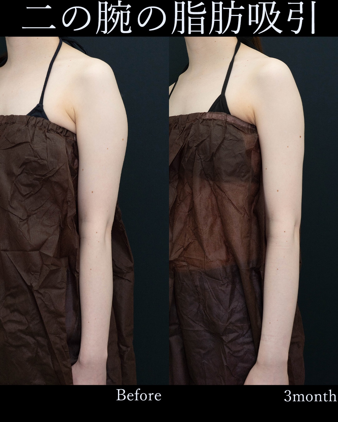 ベイザー脂肪吸引(二の腕+肩+甲横)